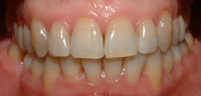 Before & Afters