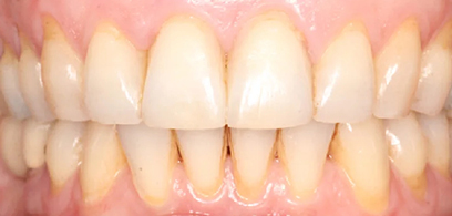 Before & Afters