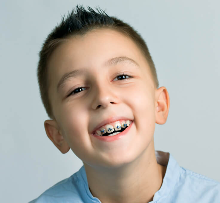 What are NHS braces? What are NHS braces?
