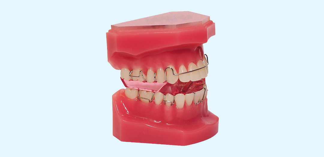 Functional Appliances