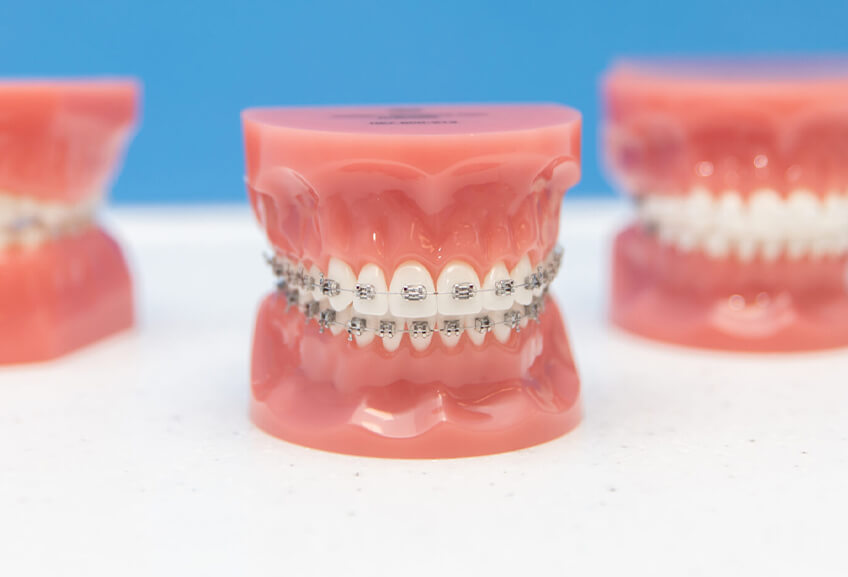 Metal fixed braces: tried and true Metal fixed braces: tried and true