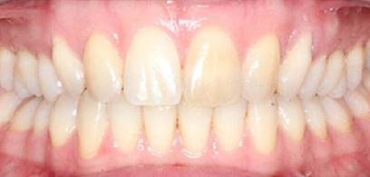 Before & Afters