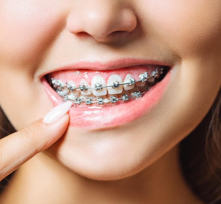 How do braces work? How do braces work?