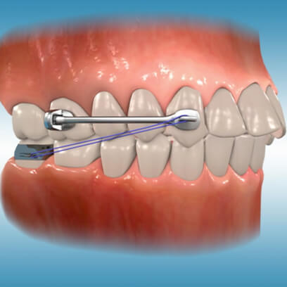 Carriere Motion Appliance