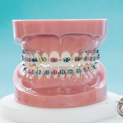 Metal fixed braces