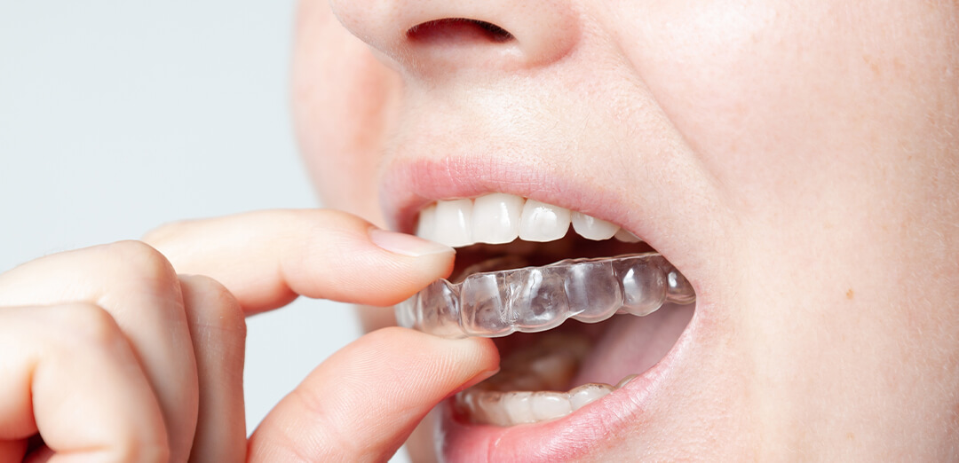 Will leaving your Invisalign aligners unattended for 3 months or longer, damage your teeth or affect treatment outcomes? Will leaving your Invisalign aligners unattended for 3 months or longer, damage your teeth or affect treatment outcomes?
