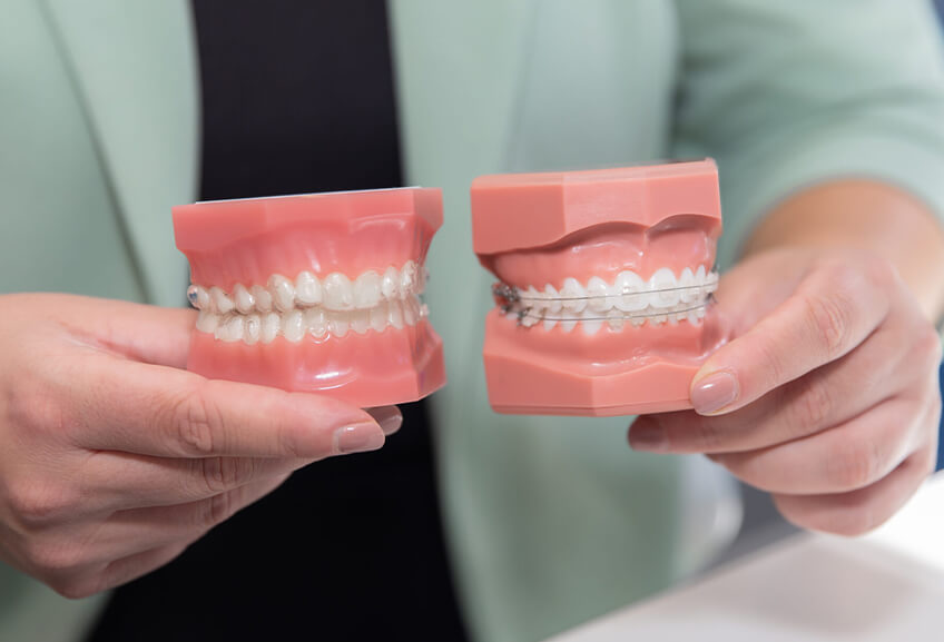 Ceramic fixed braces: braces that blend in Ceramic fixed braces: braces that blend in